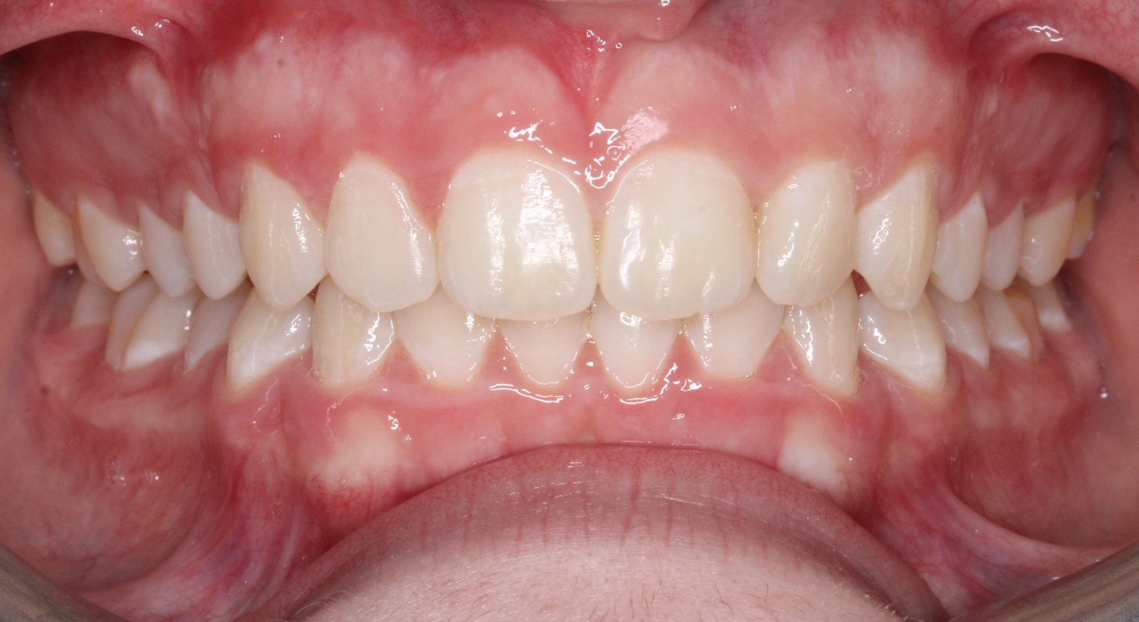 Dentadura después del tratamiento